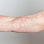 Toasted Skin Syndrome: What You Need to Know